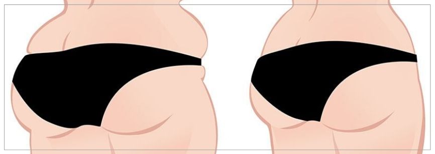 tüberöz meme - tübüler meme