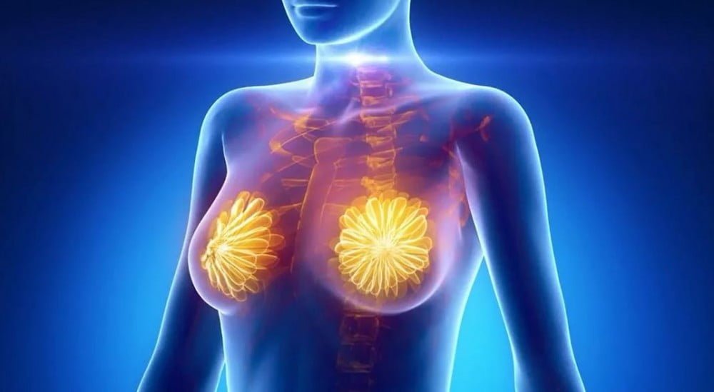 Breast Cancer