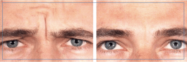 Glabella Kaş Ortası Çizgileri