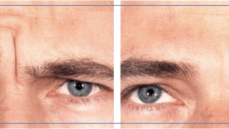 Glabella Kaş Ortası Çizgileri