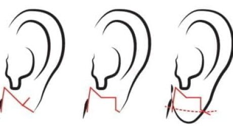 kulak memesi küçültme, ear lobe reduction, Ohrläppchenverkleinerung, 