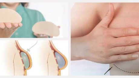 meme büyütme, breast augmentation