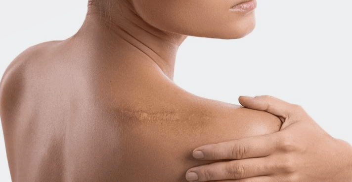 Narbengewebebehandlung