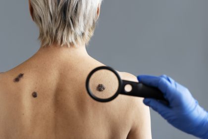 cilt kanseri, malignant melanoma cilt kanseri, malignant melanoma