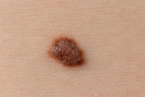 malign melanom, malignant melanoma