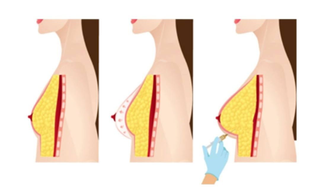 Breast Aesthetics by Fat Injection Method