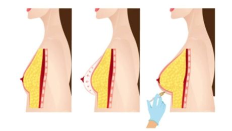 fat injection, yağ enjeksiyonu