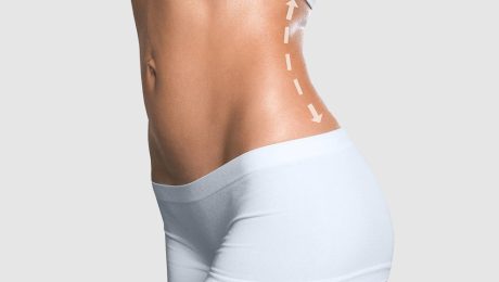 yağ aldırma ameliyatı (liposuction)