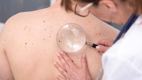 bazal hücreli deri kanseri, basal cell skin cancer