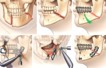 çene implantı, Kinnimplantat