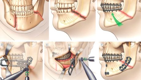 çene implantı, Kinnimplantat